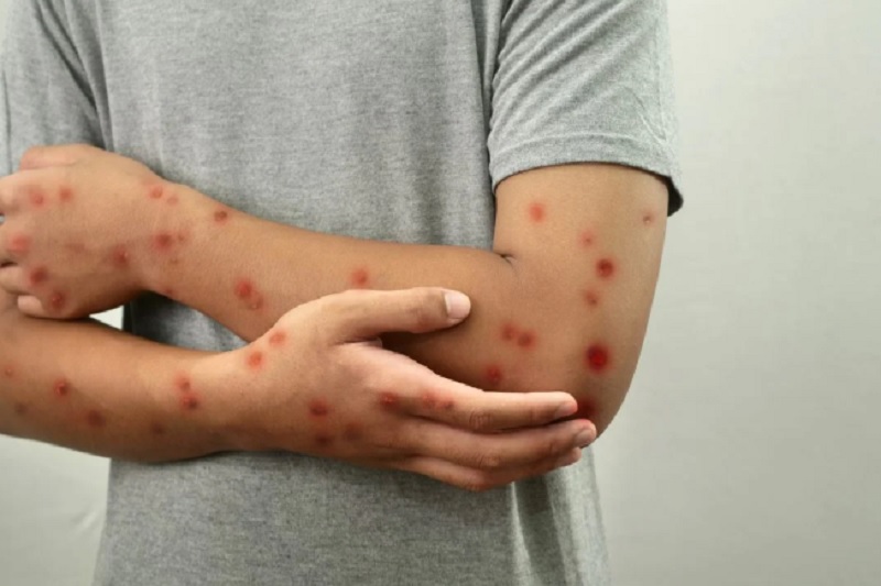 Vitória da Conquista e Salvador registram casos confirmados de Mpox na Bahia 